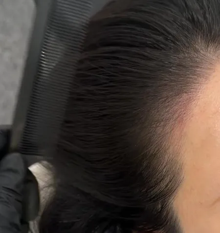 헤르민 두피문신 부산서면점